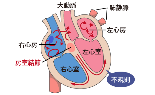 心房細動による心房の動きのイラスト